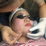 Loại da nào dễ bị mụn