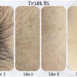 Triệt lông vùng kín 